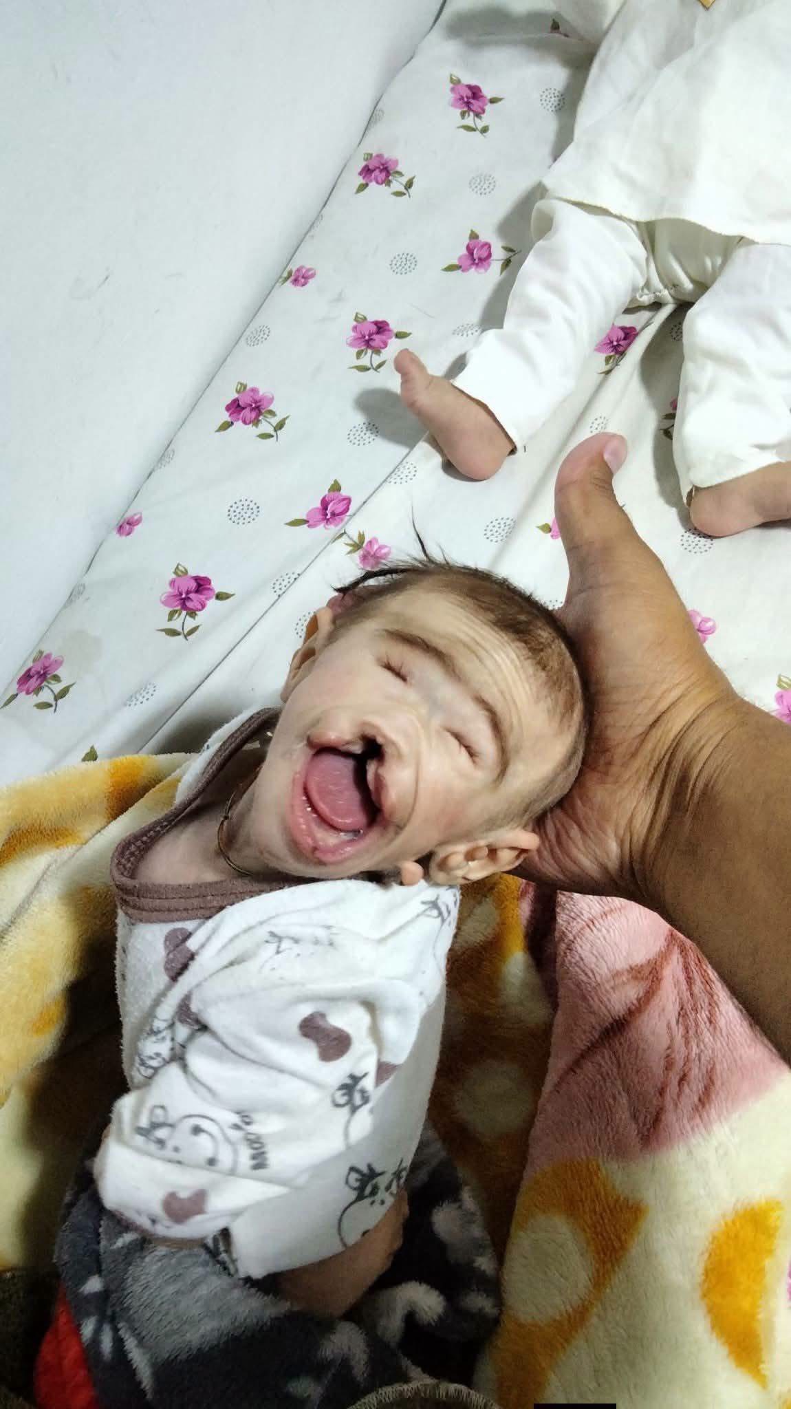 پزشکان: تولد نوزاد با ناهنجاری مادرزادی «عذاب الهی» نیست؛ کمبود اسید فولیک و مصرف خودسرانه دارو از عوامل مهم آن است